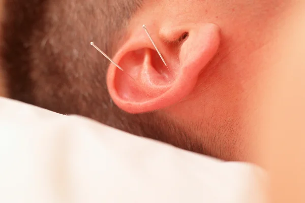agopuntura dell'orecchio per la perdita di peso